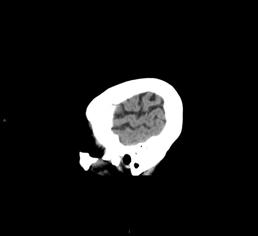 Cerebellar hemorrhage (Radiopaedia 58793-66027 C 46).jpg