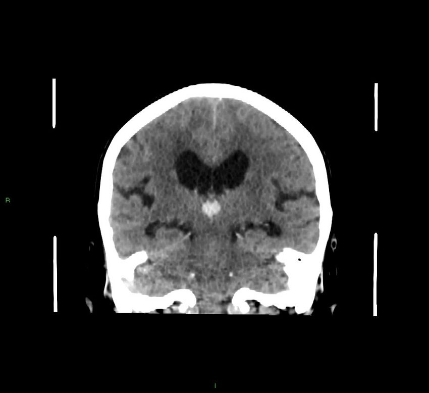 Cerebellar hemorrhage (Radiopaedia 58793-66027 Coronal non-contrast 32).jpg