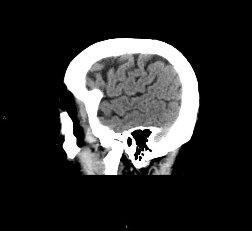 Cerebral amyloid angiopathy-associated lobar intracerebral hemorrhage (Radiopaedia 58376-65511 C 9).jpg