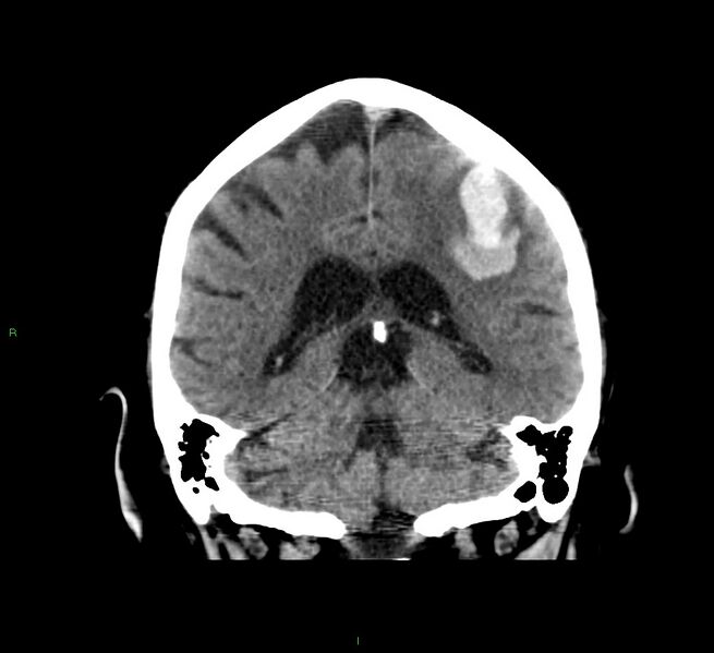 File:Cerebral amyloid angiopathy-associated lobar intracerebral hemorrhage (Radiopaedia 58376-65511 Coronal non-contrast 26).jpg