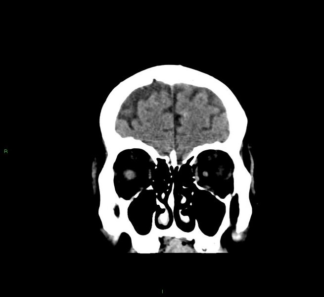 File:Cerebral amyloid angiopathy-associated lobar intracerebral hemorrhage (Radiopaedia 58376-65511 Coronal non-contrast 54).jpg