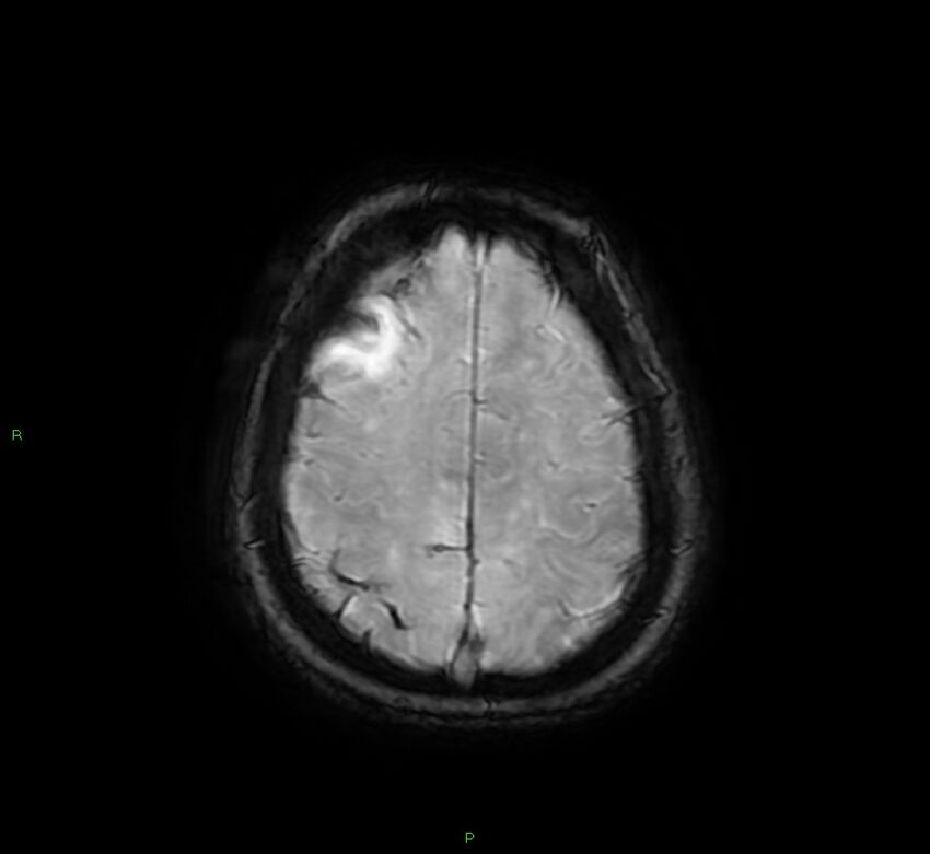 Cerebral amyloid angiopathy-associated lobar intracerebral hemorrhage (Radiopaedia 58378-65517 Axial SWI 60).jpg
