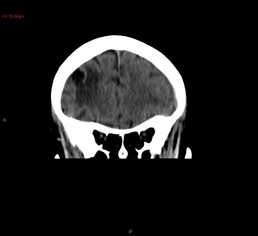 Cerebral amyloid angiopathy-associated lobar intracerebral hemorrhage (Radiopaedia 58378-65518 Coronal non-contrast 55).jpg