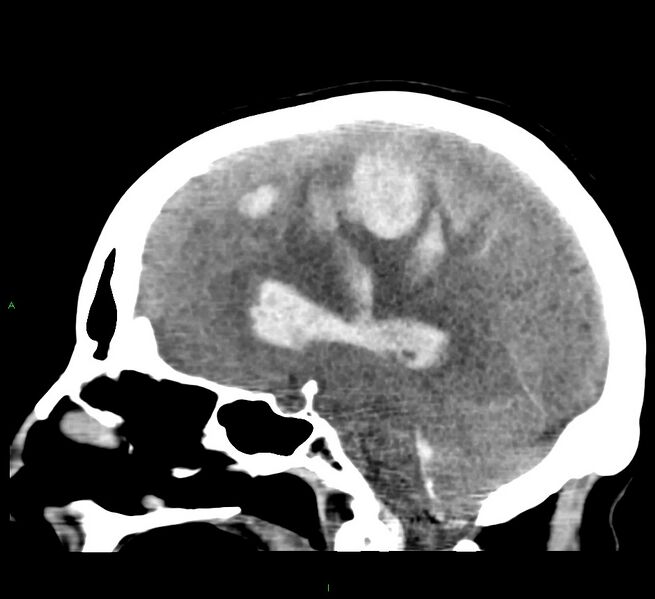 File:Cerebral amyloid angiopathy-associated lobar intracerebral hemorrhage (Radiopaedia 58379-65519 C 28).jpg