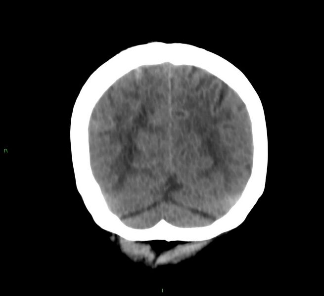 File:Cerebral amyloid angiopathy-associated lobar intracerebral hemorrhage (Radiopaedia 58566-65730 Coronal non-contrast 18).jpg