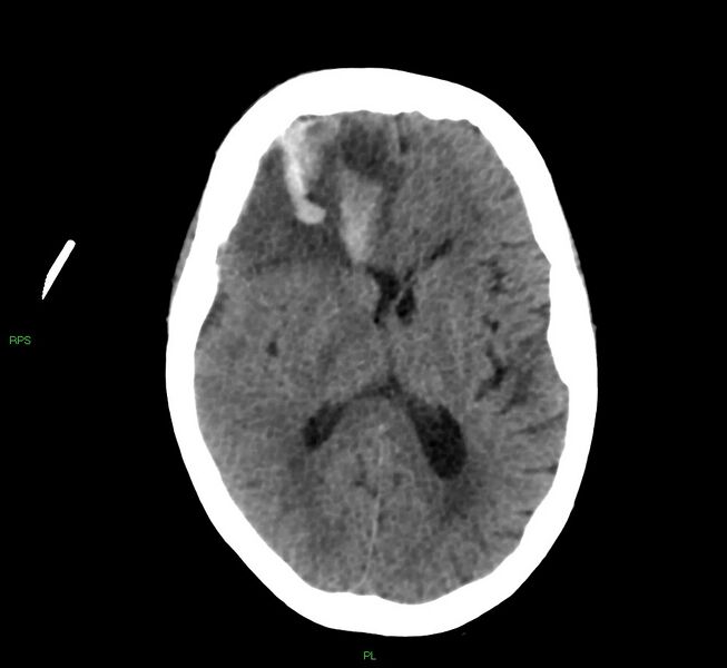 File:Cerebral amyloid angiopathy-associated lobar intracerebral hemorrhage (Radiopaedia 58569-65734 Axial non-contrast 31).jpg