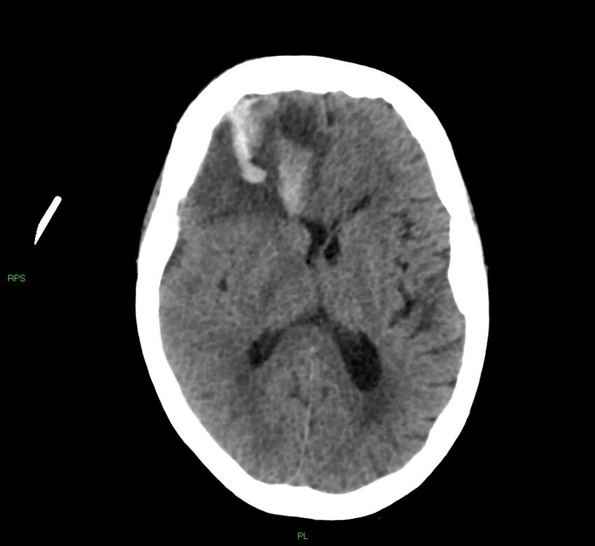 Cerebral amyloid angiopathy-associated lobar intracerebral hemorrhage (Radiopaedia 58569-65734 Axial non-contrast 31).jpg