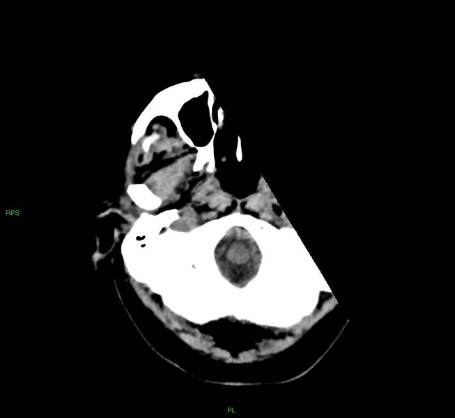 File:Cerebral amyloid angiopathy-associated lobar intracerebral hemorrhage (Radiopaedia 58569-65734 Axial non-contrast 52).jpg