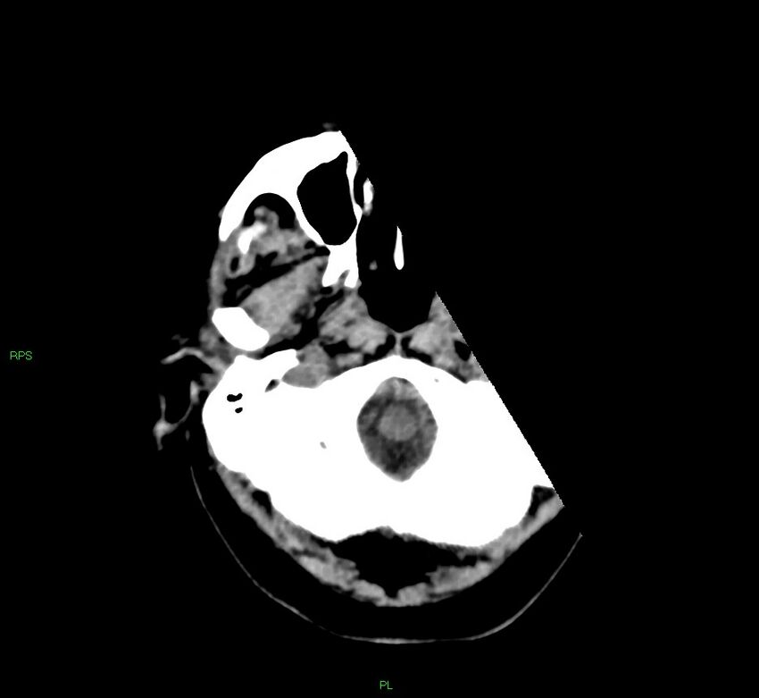 Cerebral amyloid angiopathy-associated lobar intracerebral hemorrhage (Radiopaedia 58569-65734 Axial non-contrast 52).jpg