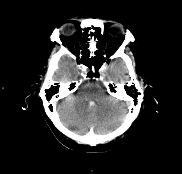 File:Cerebral amyloid angiopathy-associated lobar intracerebral hemorrhage (Radiopaedia 59356-66716 Axial non-contrast 35).jpg