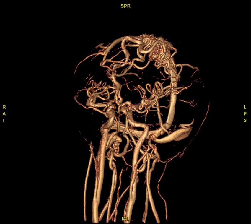 Cerebral arteriovenous malformation (Radiopaedia 61964-70029 VRT 45).jpg