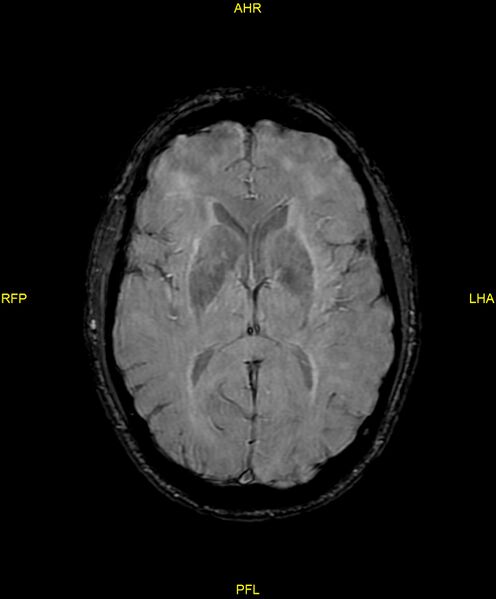 File:Cerebral autosomal dominant arteriopathy with subcortical infarcts and leukoencephalopathy (CADASIL) (Radiopaedia 86108-102054 Axial SWI 59).jpg