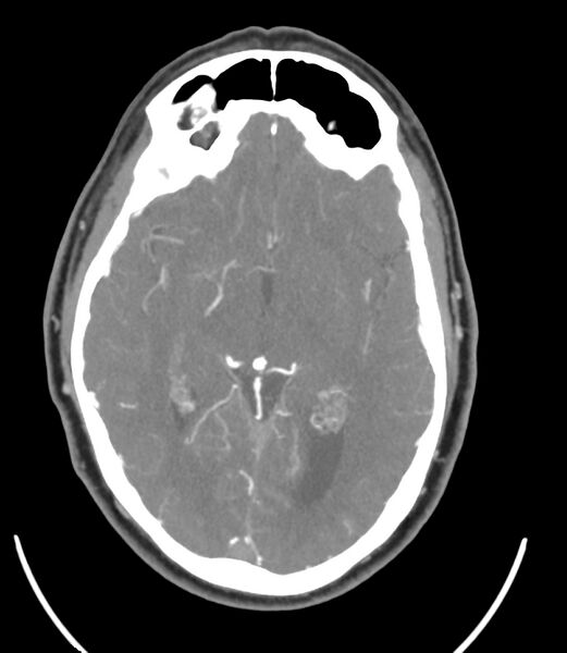 File:Cerebral dural venous sinus thrombosis (Radiopaedia 86514-102576 A 52).jpg