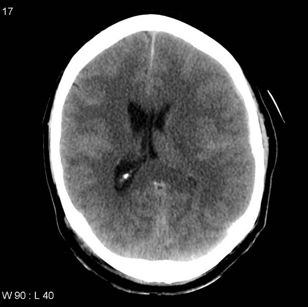 File:Cerebral hemorrhagic contusion with subdural and subarachnoid hemorrhage (Radiopaedia 10680-19197 Axial non-contrast 13).jpg