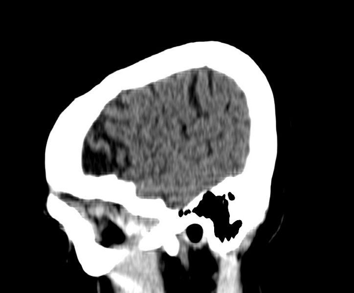 File:Cerebral venous thrombosis - CT only (Radiopaedia 41031-43778 B 2).jpg