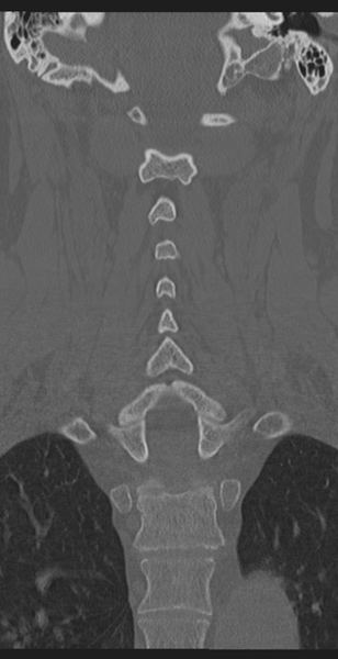 File:Cervical canal stenosis due to ossification of the posterior longitudinal ligament (Radiopaedia 47260-51823 Coronal bone window 38).png