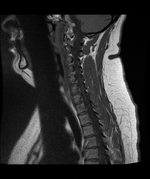 File:Cervical disc prolapse (Radiopaedia 80258-93598 Sagittal T1 5).jpg