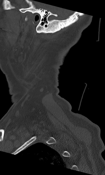 File:Cervical spine fracture - chalk stick (Radiopaedia 39116-41323 Sagittal bone window 60).png