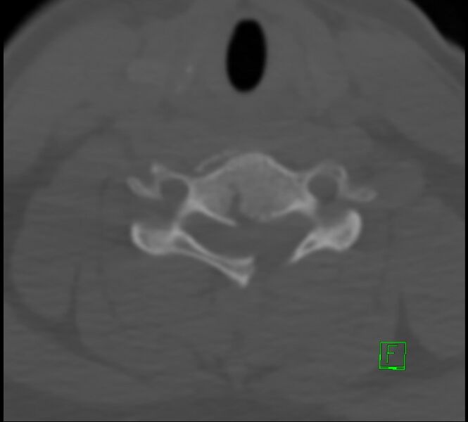 File:Cervical spine fracture - hyperflexion injury (Radiopaedia 66184-75364 Axial bone window 31).jpg