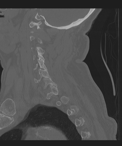 File:Cervical spine fracture in the setting of ankylosis (Radiopaedia 37038-38715 Sagittal bone window 24).png