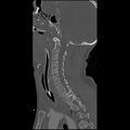 Cervical spine fractures with vertebral artery dissection (Radiopaedia 32135-33078 Sagittal bone window 23).jpg