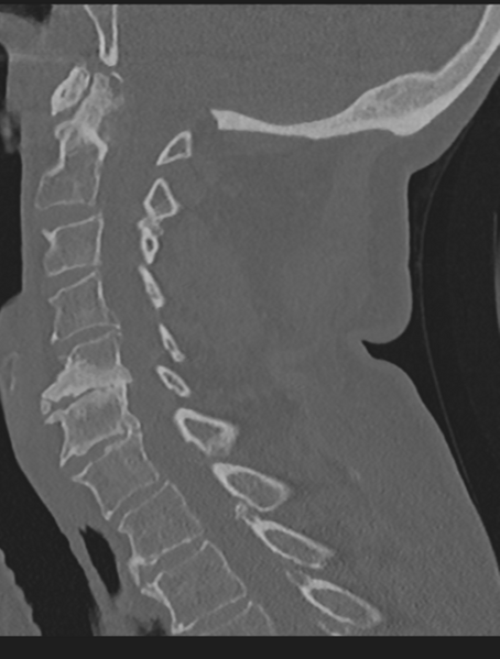 File:Cervical spondylolysis (Radiopaedia 49616-54811 Sagittal bone window 41).png