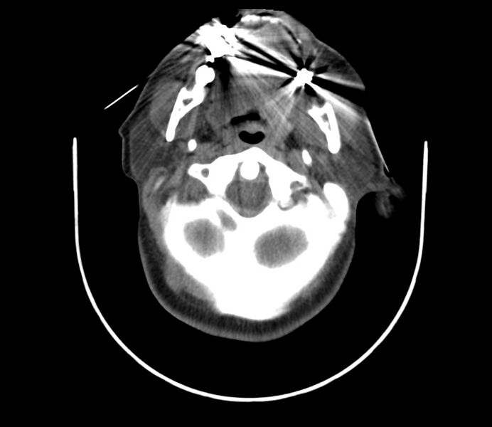 File:Cervical venous malformation (Radiopaedia 22653-22672 Axial non-contrast 20).jpg