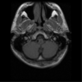 Cervical vertebrae metastasis (Radiopaedia 78814-91667 Axial T1 16).png