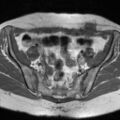 Cesarian section scar endometriosis (Radiopaedia 66520-75799 Axial T1 5).jpg