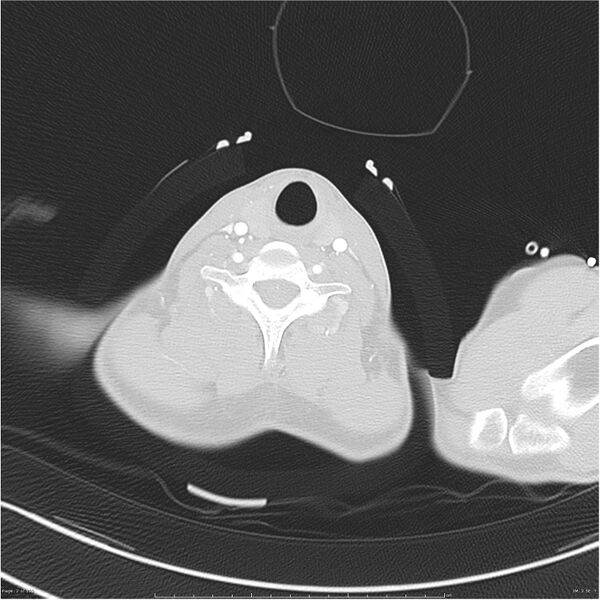 File:Chest and abdomen multi-trauma (Radiopaedia 26294-26425 lung window 2).jpg