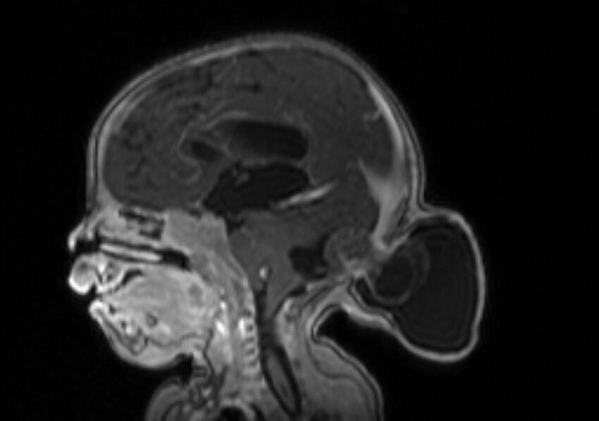 Chiari III malformation with occipital encephalocele (Radiopaedia 79446-92559 Sagittal T1 C+ mpr 37).jpg
