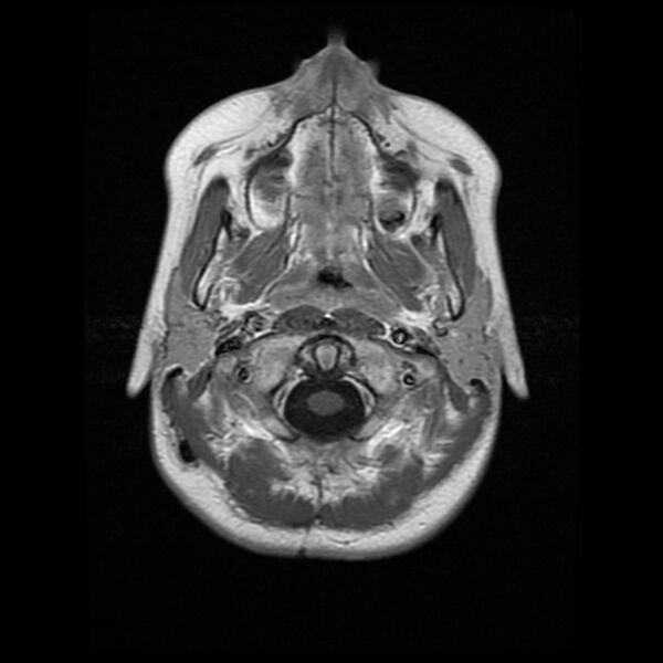 File:Chiasmatic-hypothalamic juvenile pilocytic astrocytoma (Radiopaedia 78533-91236 Axial T1 C+ 3).jpg