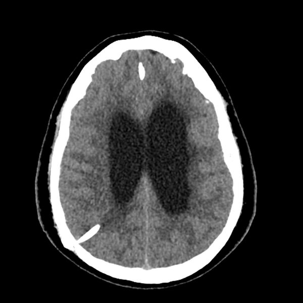 File:Chiasmatic-hypothalamic juvenile pilocytic astrocytoma (Radiopaedia 78533-91237 Axial non-contrast 40).jpg