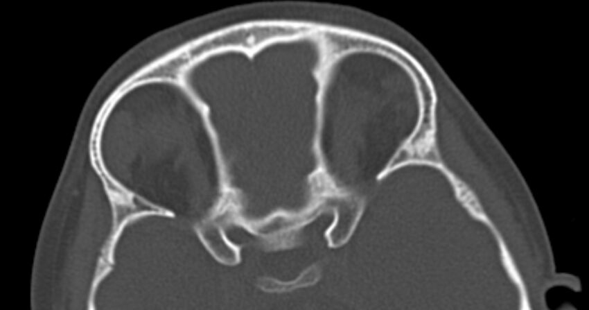 Choanal atresia (Radiopaedia 51295-56972 Axial bone window 58).jpg