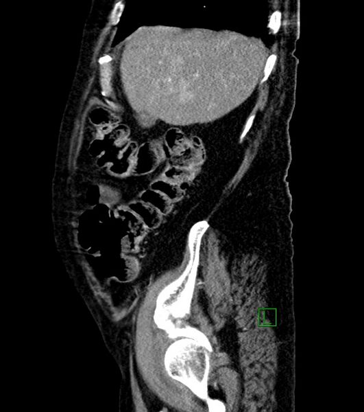 File:Cholangiocarcinoma with cerebral metastases (Radiopaedia 83519-98629 F 96).jpg