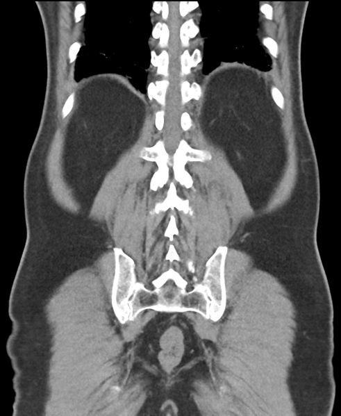 File:Cholecystitis with focal perforation and hepatic abscess (Radiopaedia 37189-38945 Coronal non-contrast 47).png