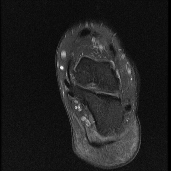 File:Chondroblastoma - midfoot (Radiopaedia 64831-73765 E 2).jpg