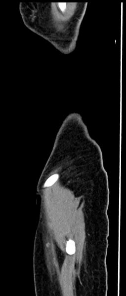 File:Choriocarcinoma liver metastases (Radiopaedia 74768-85766 C 33).jpg