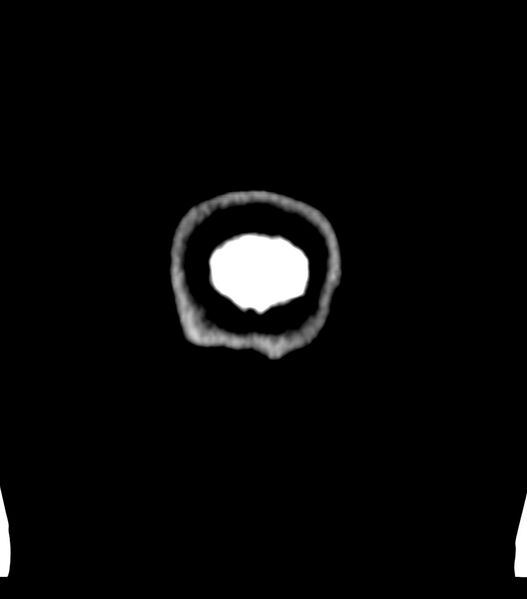 File:Choroid plexus carcinoma (Radiopaedia 91013-108552 Coronal non-contrast 89).jpg