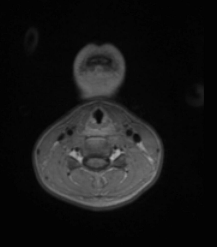 Choroid plexus carcinoma (Radiopaedia 91013-108553 Axial T1 C+ 5).jpg