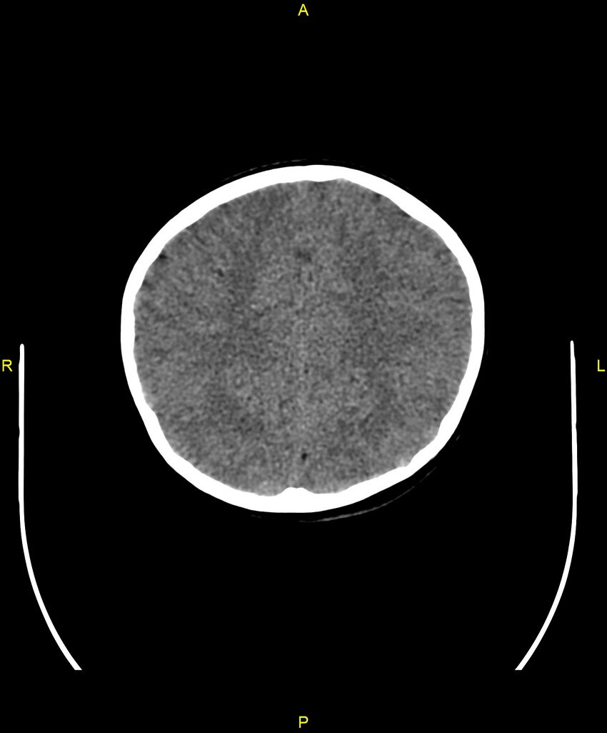 Choroidal fissure cyst (Radiopaedia 89481-106465 Axial non-contrast 87).jpg