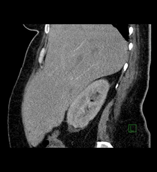 File:Chromophobe renal cell carcinoma (Radiopaedia 84239-99519 D 88).jpg