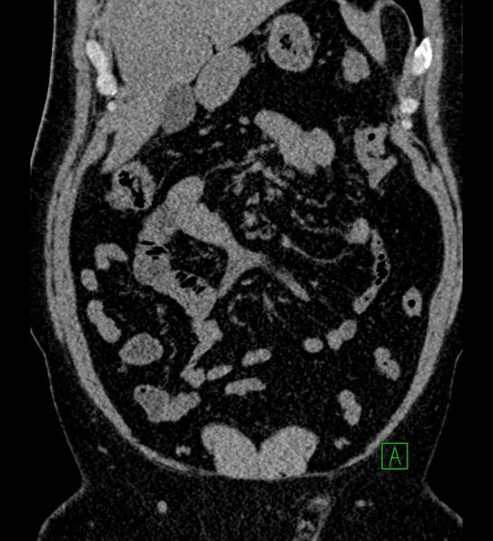 File:Chromophobe renal cell carcinoma (Radiopaedia 84286-99573 Coronal non-contrast 50).jpg