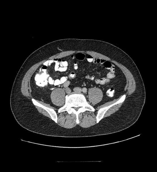 File:Chromophobe renal cell carcinoma (Radiopaedia 84337-99644 C 89).jpg