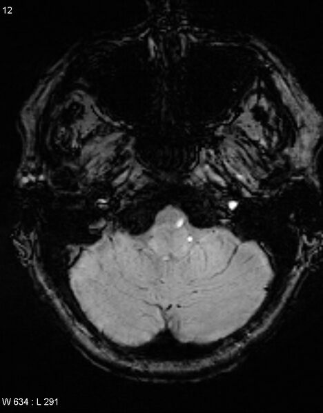 File:Chronic lymphocytic inflammation with pontine perivascular enhancement responsive to steroids (CLIPPERS) (Radiopaedia 37520-39374 Axial SWI 11).jpg