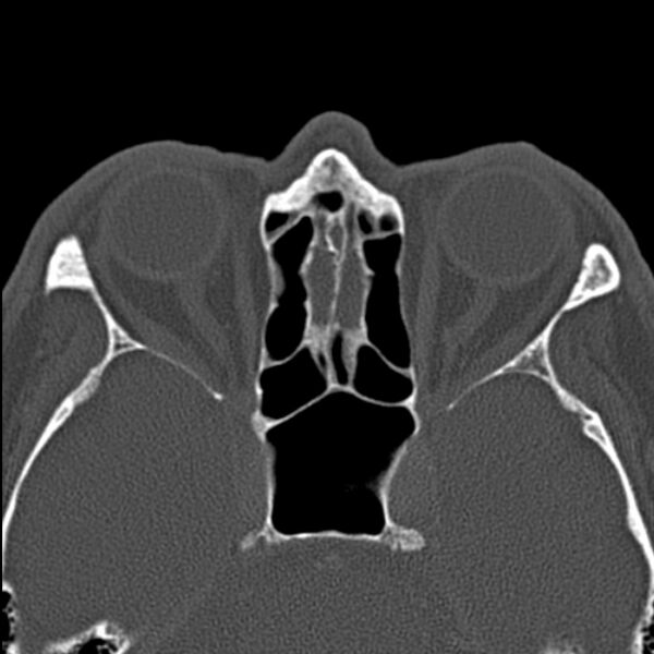 File:Chronic maxillary sinusitis (Radiopaedia 27879-28116 Axial bone window 36).jpg
