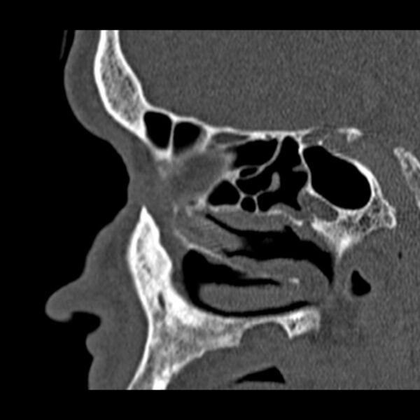 File:Chronic maxillary sinusitis (Radiopaedia 27879-28116 Sagittal bone window 36).jpg