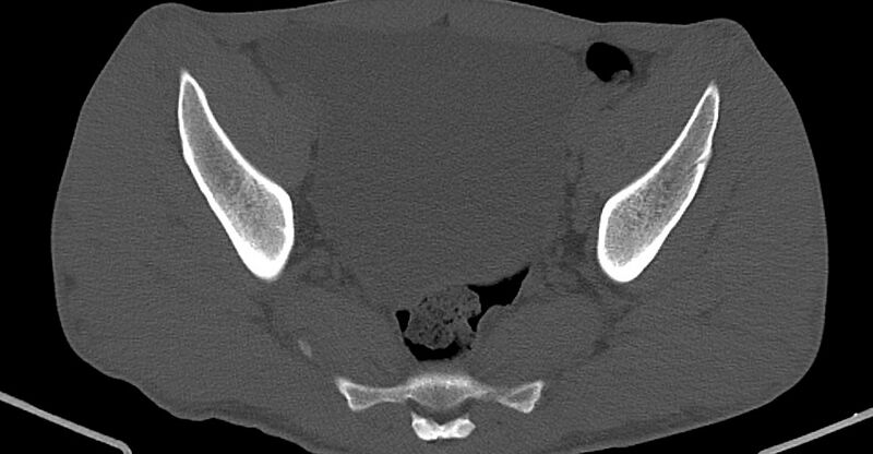 File:Chronic osteomyelitis (with sequestrum) (Radiopaedia 74813-85822 Axial non-contrast 21).jpg