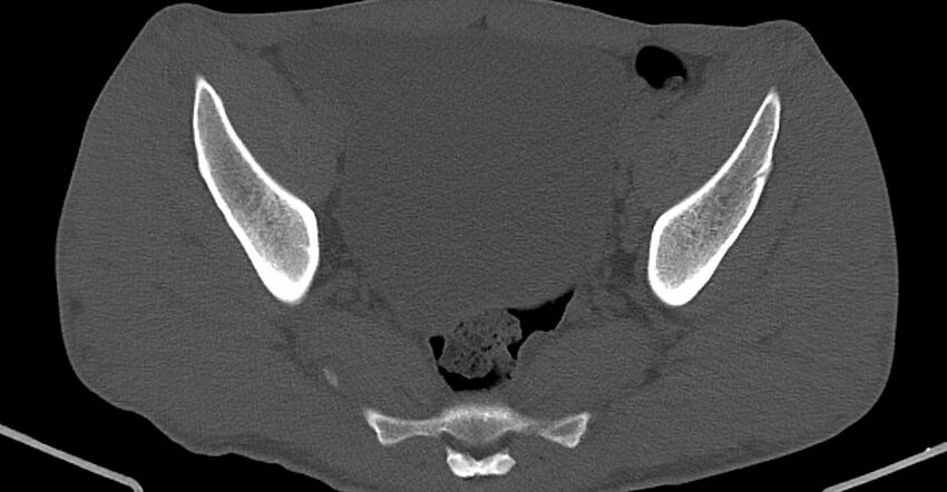 Chronic osteomyelitis (with sequestrum) (Radiopaedia 74813-85822 Axial non-contrast 21).jpg