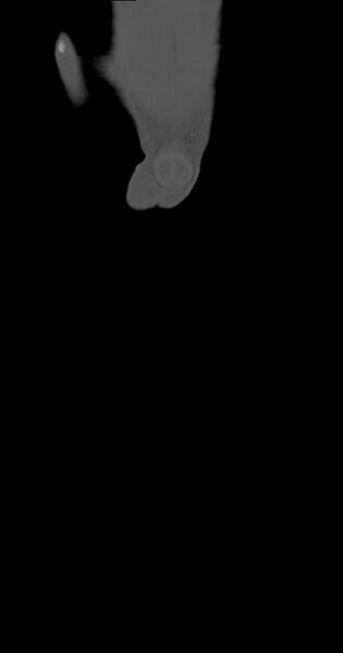File:Chronic osteomyelitis (with sequestrum) (Radiopaedia 74813-85822 Coronal non-contrast 2).jpg